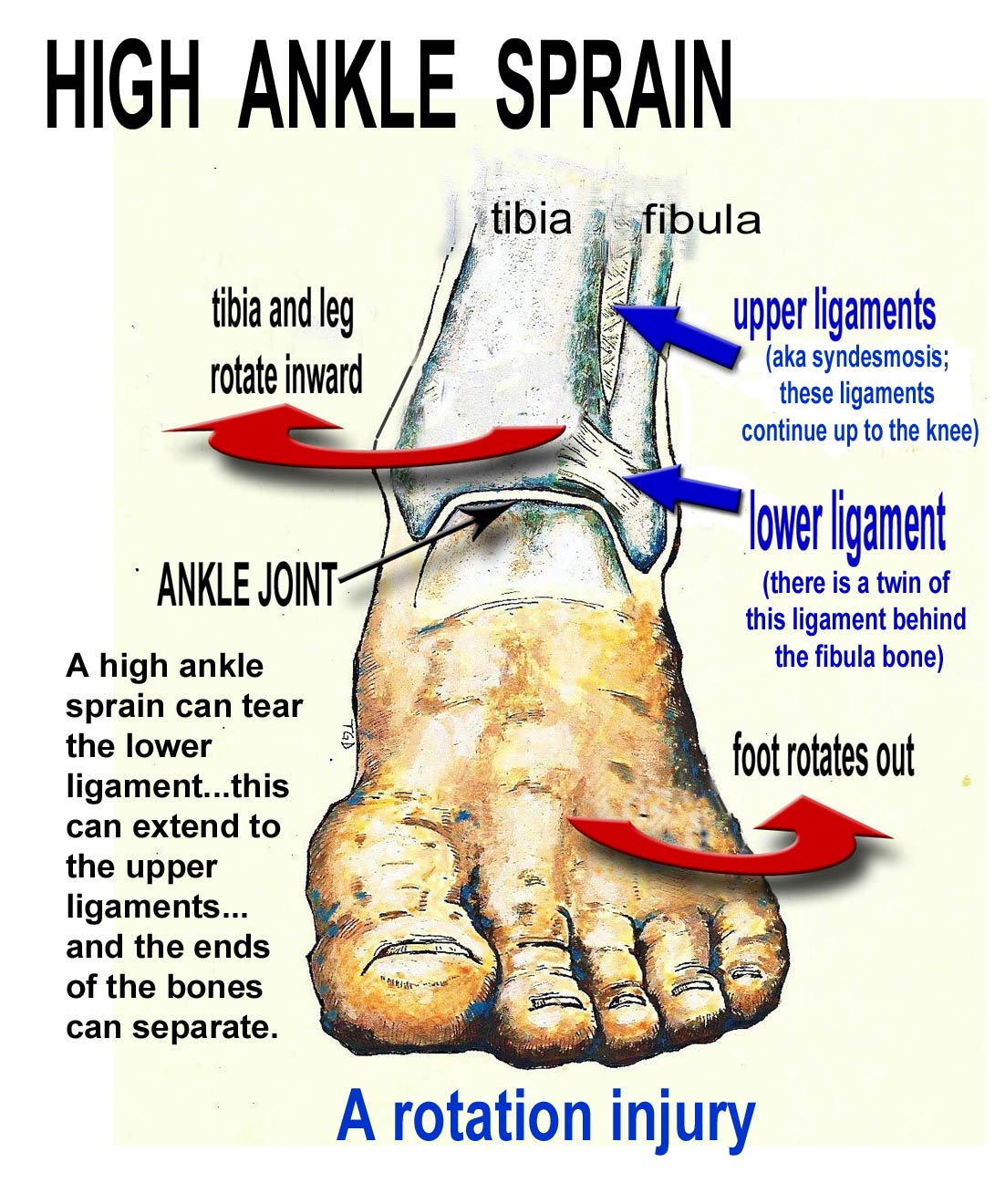 soccer-high-ankle-sprain.jpg